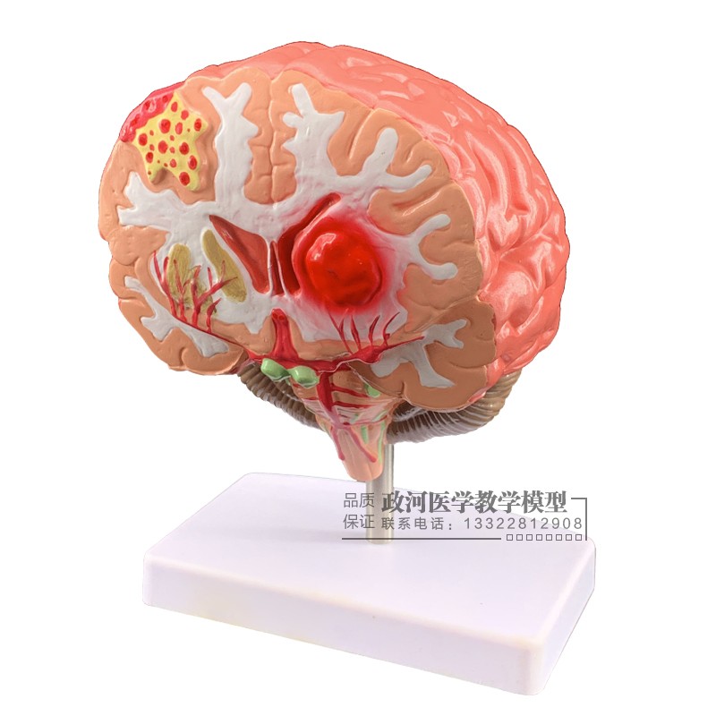 仿真人体脑部f疾病模型大脑解剖神经内外科脑病理大脑病变模型