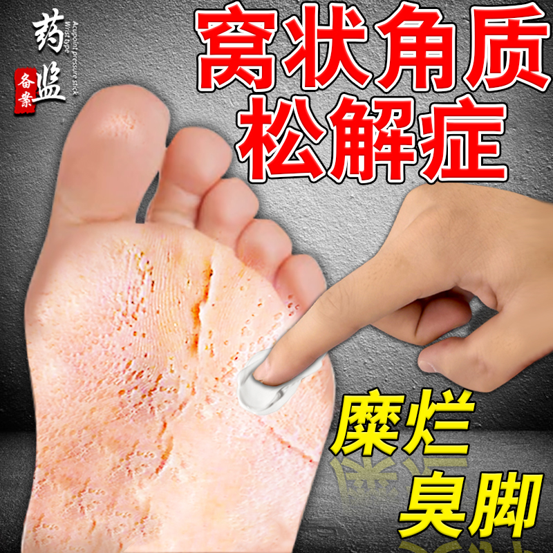 窝状角质松解症脚底发白糜烂性臭脚蜂窝状脚气真菌感染沙虫脚软膏