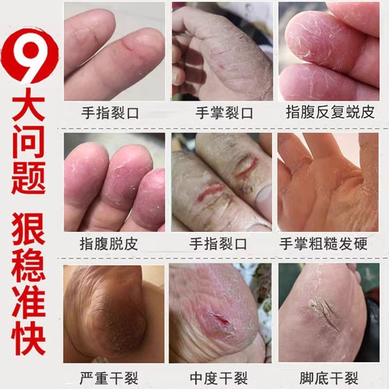 专治手裂的药膏防皲裂手脚干裂手指开裂口脱皮干燥粗糙专用防裂膏
